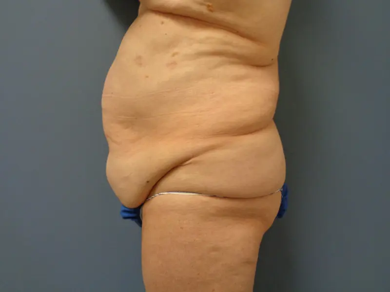 Tummy Tuck Before and After Pictures Nashville, TN