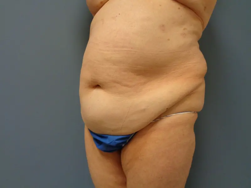 Tummy Tuck Before and After Pictures Nashville, TN