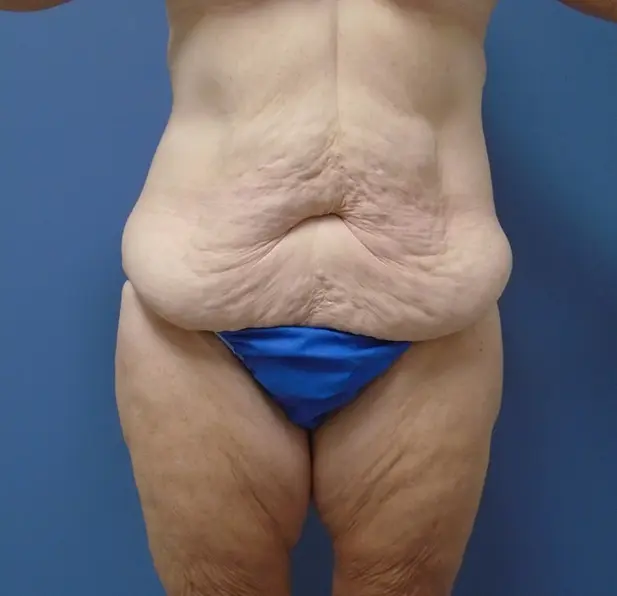 Body Lift Before and After Pictures Nashville, TN