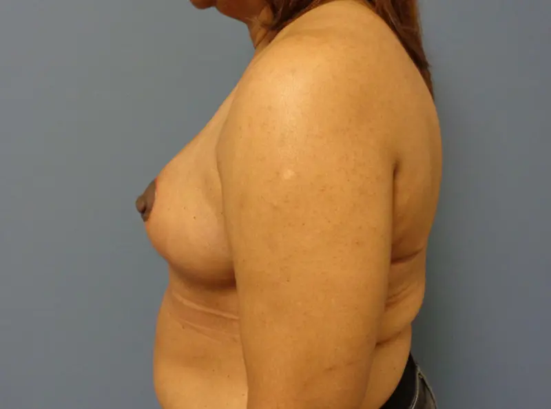 Breast Reduction Before and After Pictures Nashville, TN