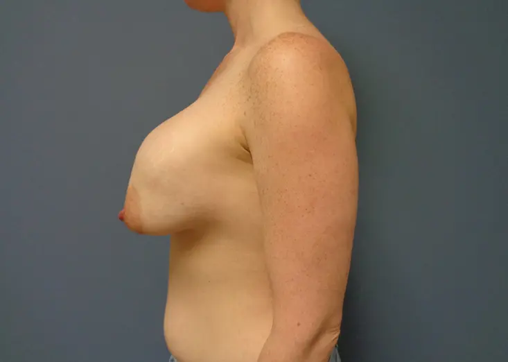 Implant Exchange/Removal Before and After Pictures Nashville, TN