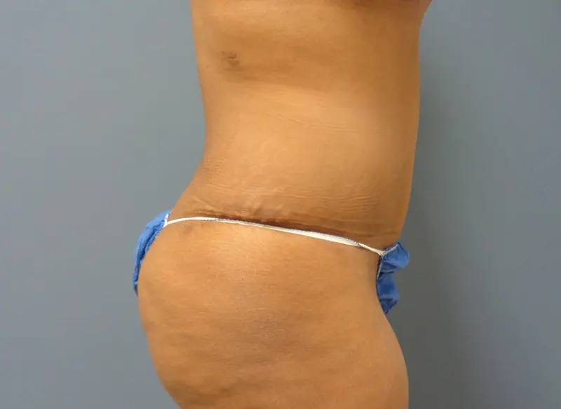 Mommy Makeover Before and After Pictures Nashville, TN