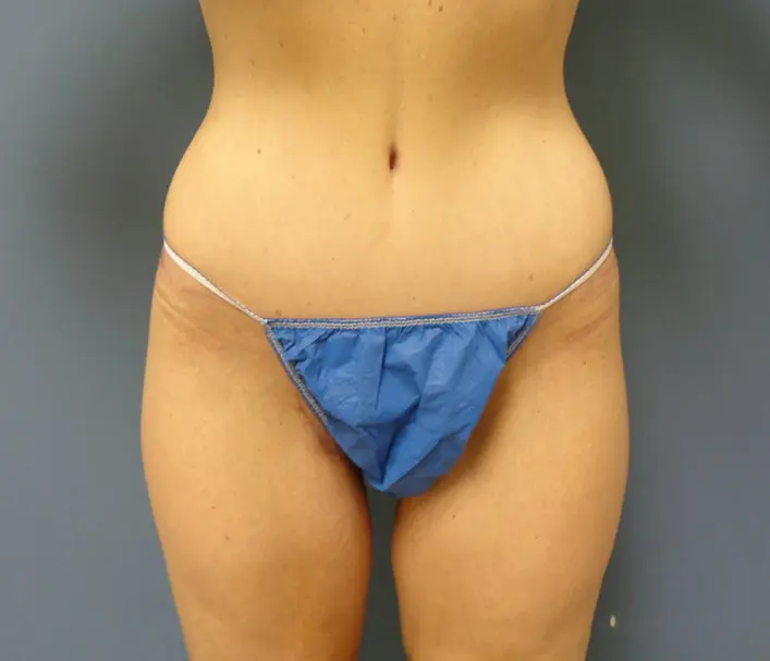 Body Lift Before and After Pictures Nashville, TN