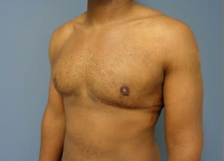 Gynecomastia Before and After Pictures Nashville, TN