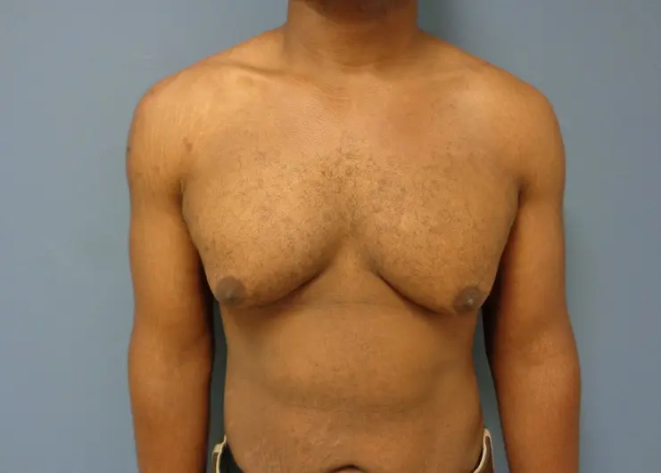 Gynecomastia Before and After Pictures Nashville, TN