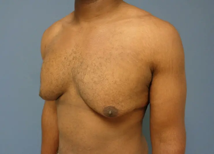 Gynecomastia Before and After Pictures Nashville, TN