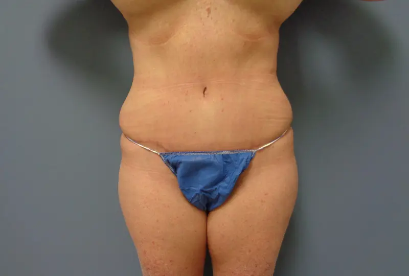 Tummy Tuck Before and After Pictures Nashville, TN