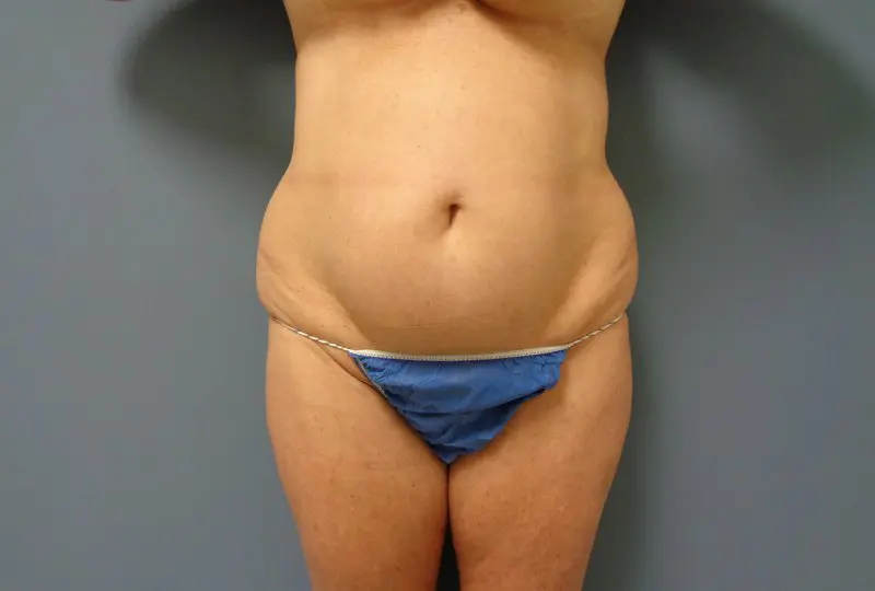 Tummy Tuck Before and After Pictures Nashville, TN