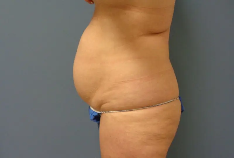 Tummy Tuck Before and After Pictures Nashville, TN