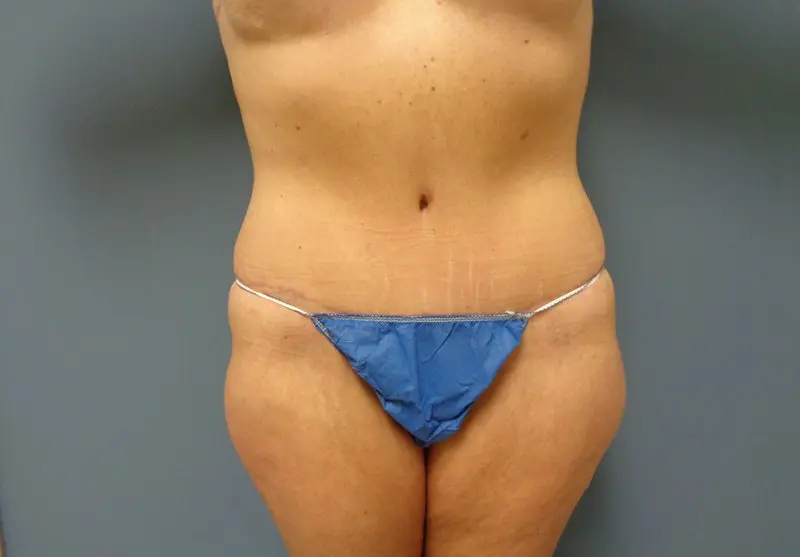 Tummy Tuck Before and After Pictures Nashville, TN