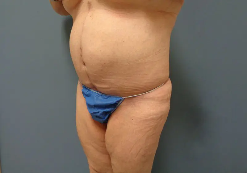 Tummy Tuck Before and After Pictures Nashville, TN
