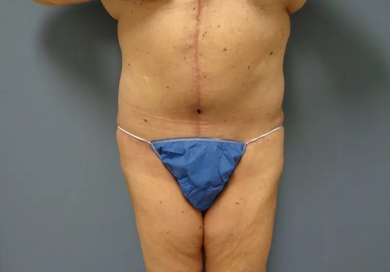 Tummy Tuck Before and After Pictures Nashville, TN