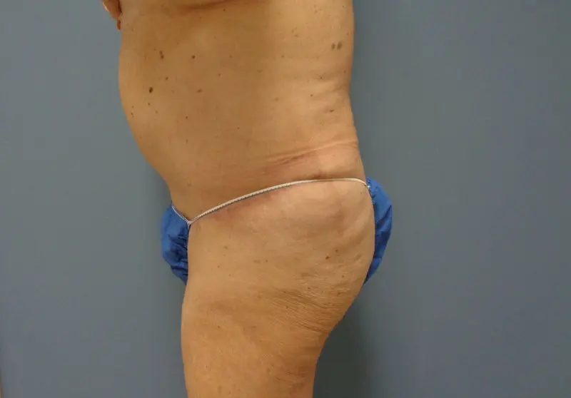 Tummy Tuck Before and After Pictures Nashville, TN
