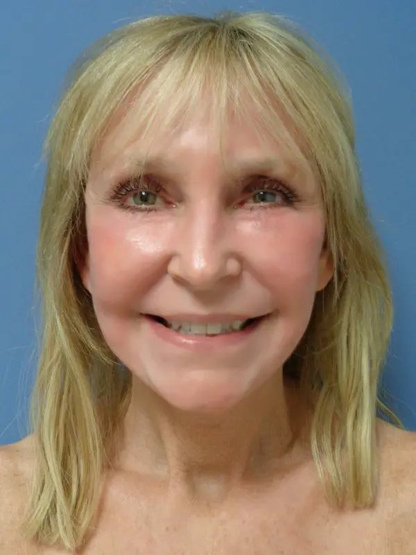 Facelift Before and After Pictures Nashville, TN