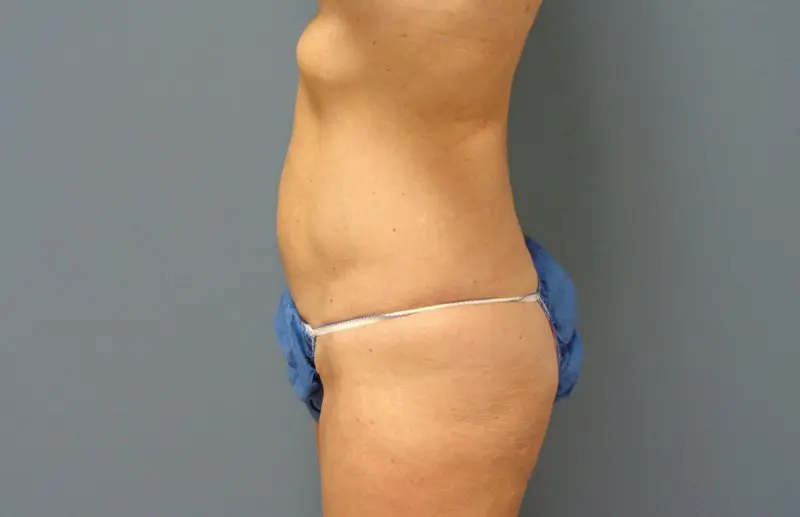 Liposuction Before and After Pictures Nashville, TN