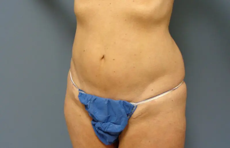 Liposuction Before and After Pictures Nashville, TN
