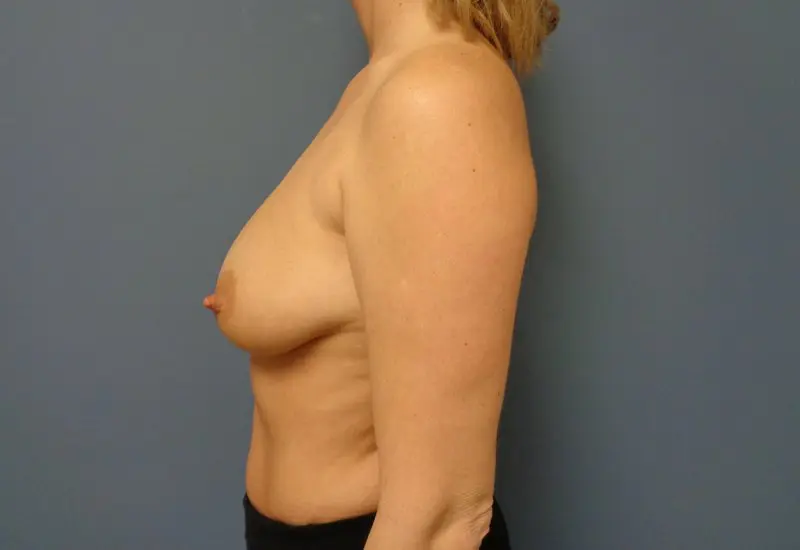 Breast Augmentation with Lift Before and After Pictures Nashville, TN