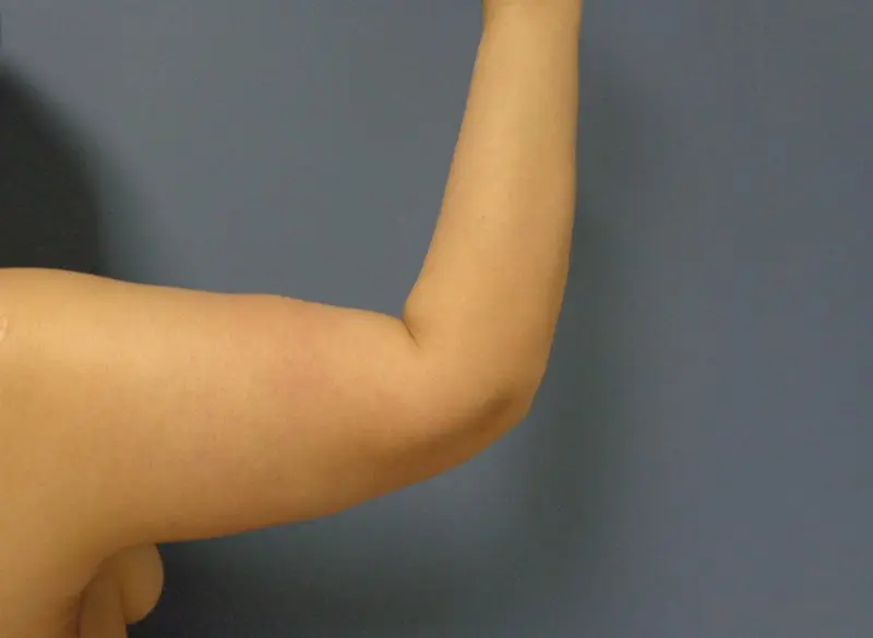 Arm Lift Before and After Pictures Nashville, TN