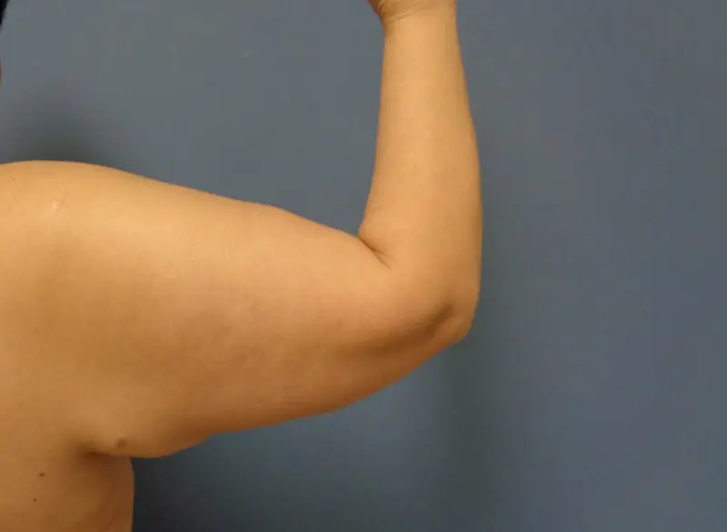 Arm Lift Before and After Pictures Nashville, TN