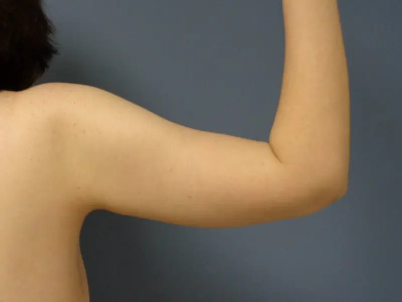 Arm Lift Before and After Pictures Nashville, TN