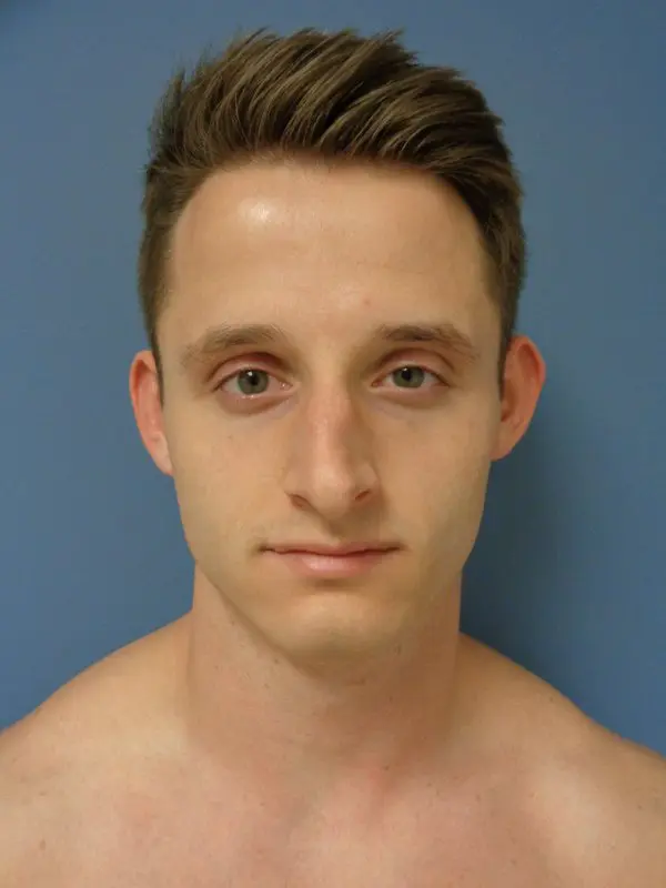 Otoplasty Before and After Pictures Nashville, TN