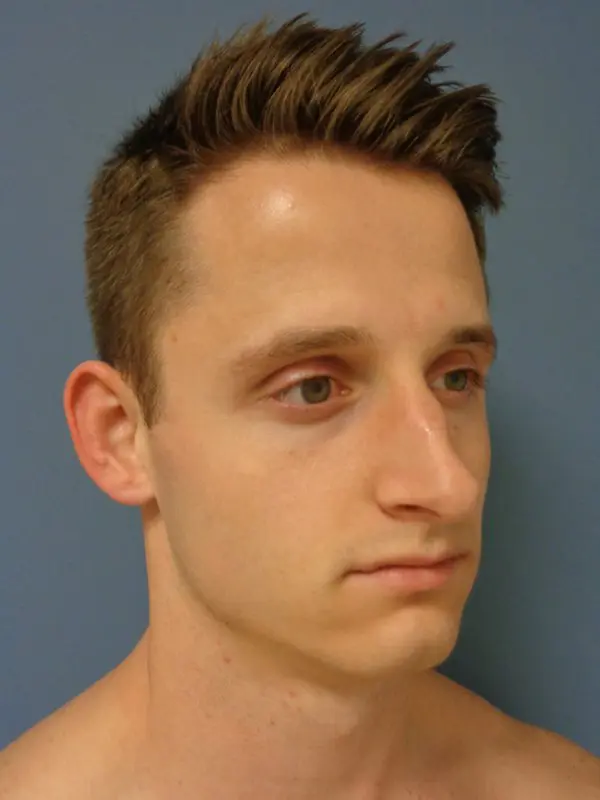 Otoplasty Before and After Pictures Nashville, TN