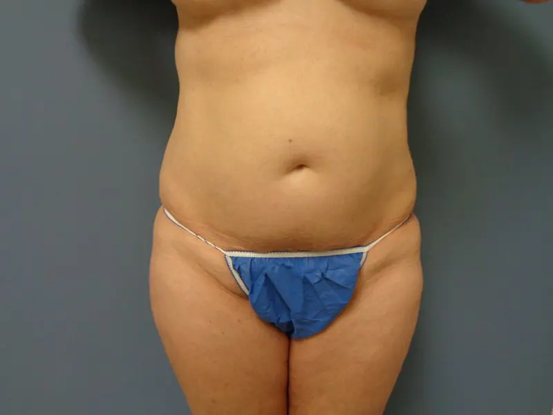 Tummy Tuck Before and After Pictures Nashville, TN