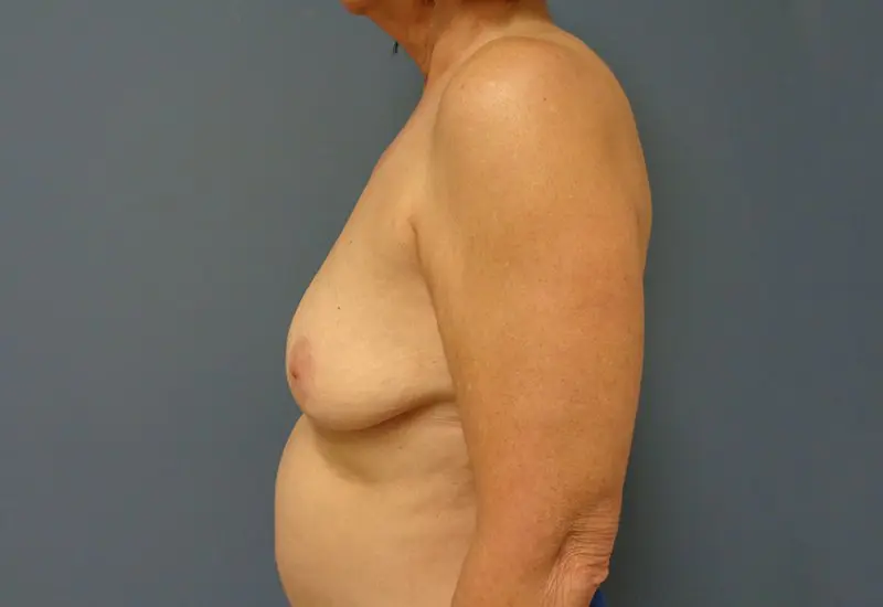 Implant Exchange/Removal Before and After Pictures Nashville, TN