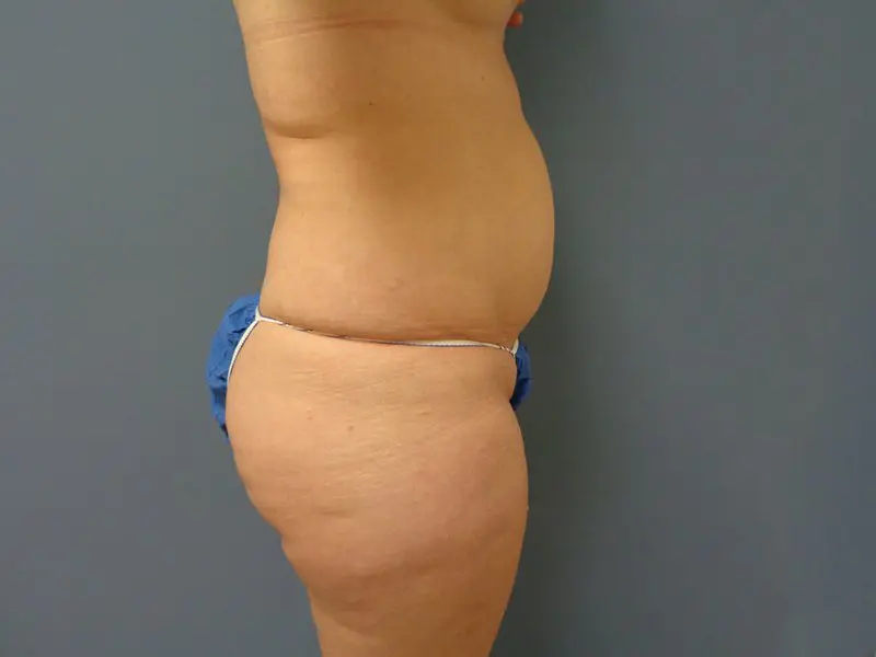 Tummy Tuck Before and After Pictures Nashville, TN