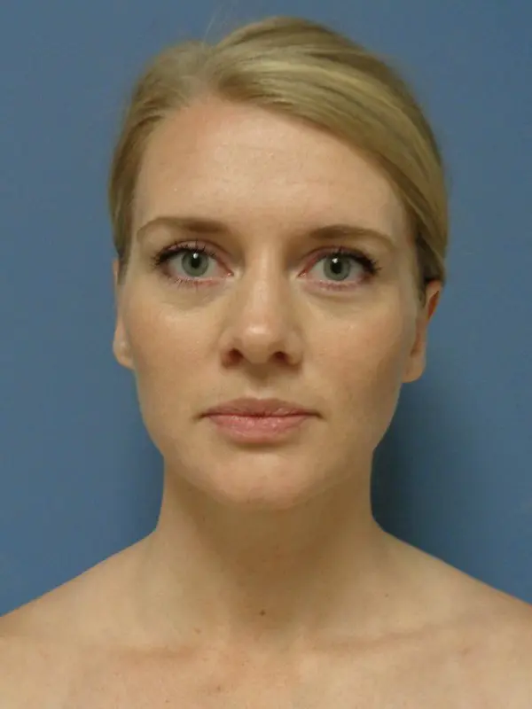 Otoplasty Before and After Pictures Nashville, TN
