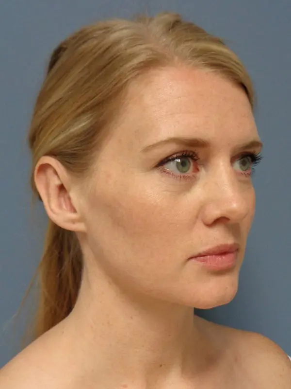Otoplasty Before and After Pictures Nashville, TN