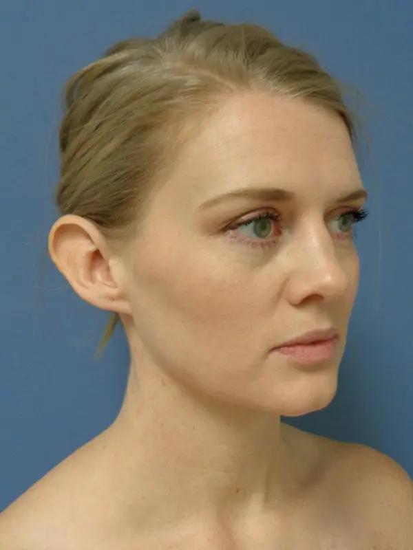 Otoplasty Before and After Pictures Nashville, TN