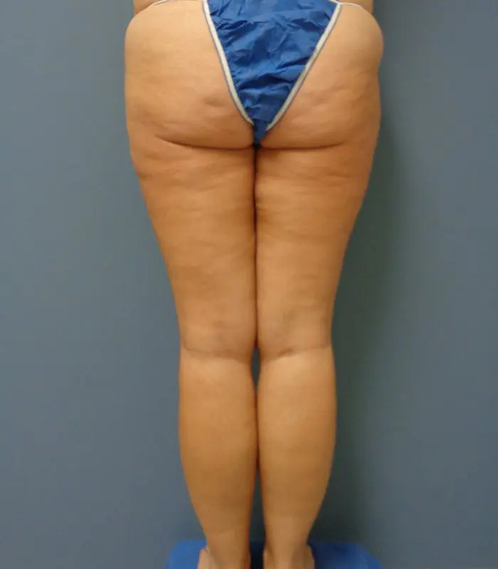 Thigh Lift Before and After Pictures Nashville, TN