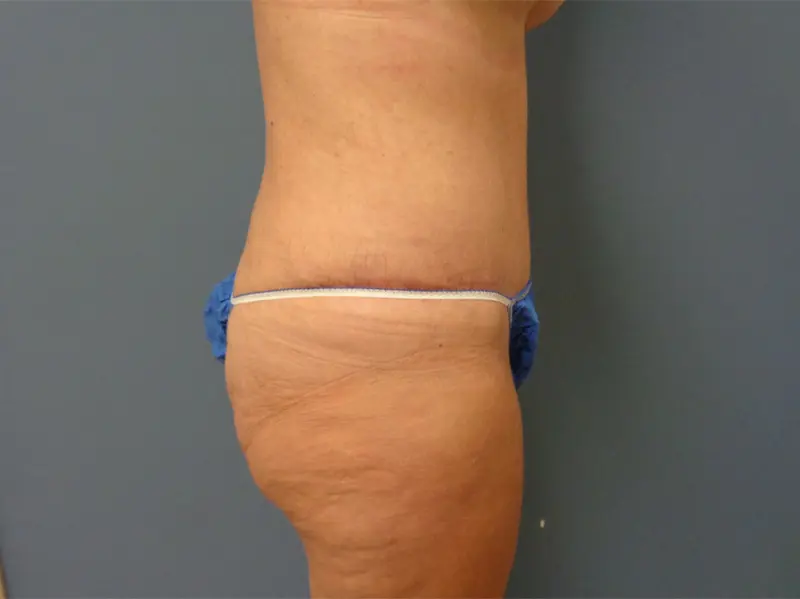 Tummy Tuck Before and After Pictures Nashville, TN