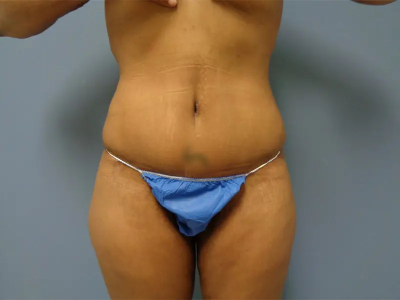 Tummy Tuck Before and After Pictures Nashville, TN