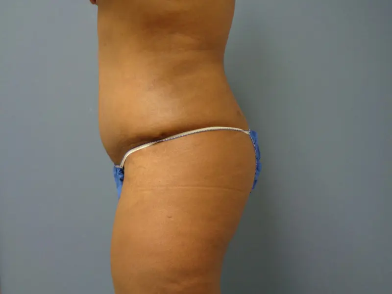 Tummy Tuck Before and After Pictures Nashville, TN