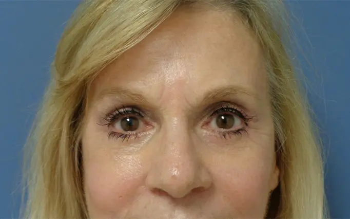 Blepharoplasty Before and After Pictures Nashville, TN