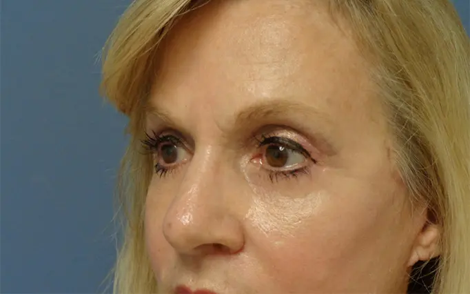 Blepharoplasty Before and After Pictures Nashville, TN