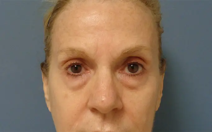 Blepharoplasty Before and After Pictures Nashville, TN