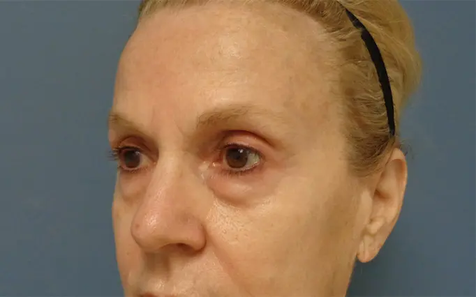 Blepharoplasty Before and After Pictures Nashville, TN