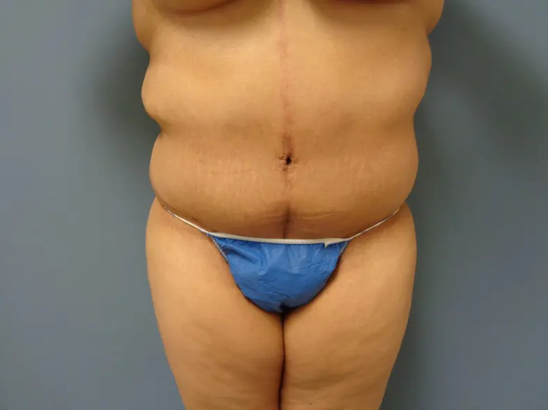 Tummy Tuck Before and After Pictures Nashville, TN