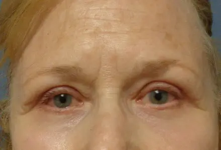 Blepharoplasty Before and After Pictures Nashville, TN