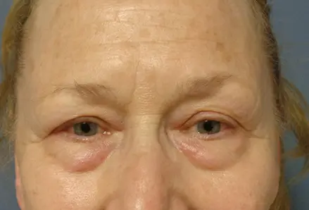Blepharoplasty Before and After Pictures Nashville, TN