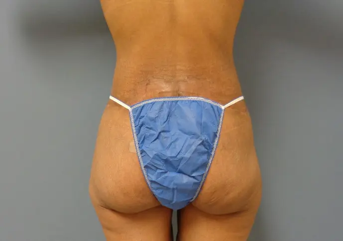 Body Lift Before and After Pictures Nashville, TN