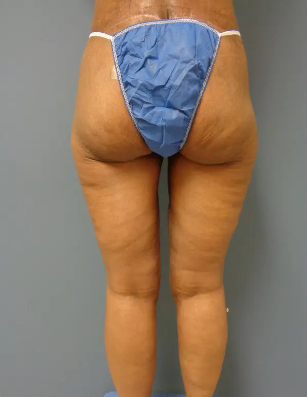 Thigh Lift Before and After Pictures Nashville, TN
