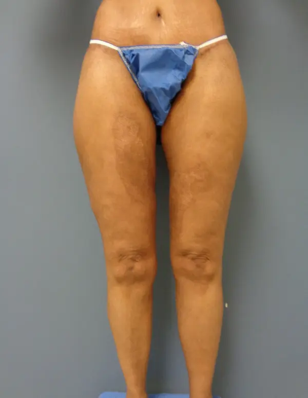 Thigh Lift Before and After Pictures Nashville, TN