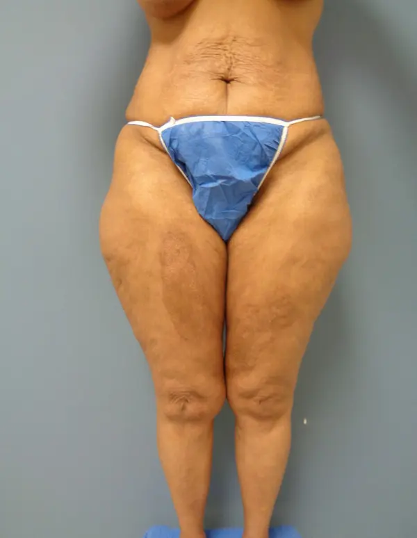 Thigh Lift Before and After Pictures Nashville, TN