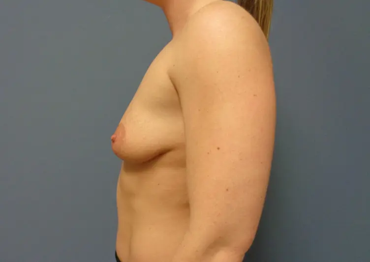 Breast Augmentation with Lift Before and After Pictures Nashville, TN