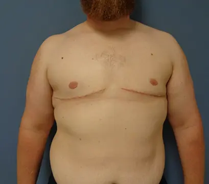 Gynecomastia Before and After Pictures Nashville, TN