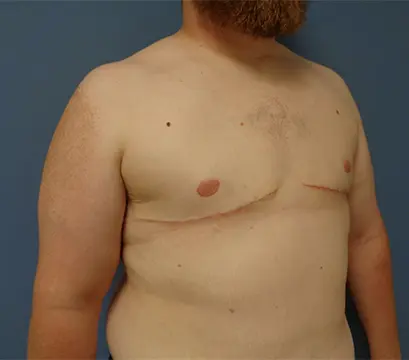 Gynecomastia Before and After Pictures Nashville, TN